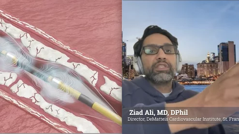 Ziad Ali, MD, DPhil, director of the DeMatteis Cardiovascular Institute, St. Francis Hospital and Heart Center, spoke with Cardiovascular Business about his center's experience using the recently released Johnson &amp; Johnson MedTech next-generation Shockwave C2 Aero Coronary IVL Catheter to treat calcified coronary artery disease. Ali said his center was the first in the world to use the catheter in August 2025 and has since gained experience in roughly 80 cases.