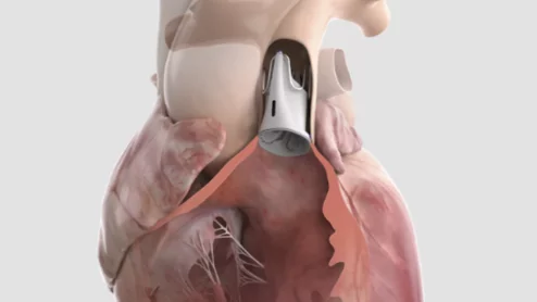The Autus pulmonary heart valve is adjustable so it can grow with congenital heart patients as they age.