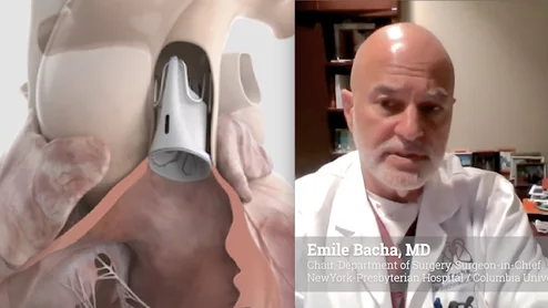 Emile Bacha, MD, chair, Department of Surgery, surgeon-in-chief at NewYork-Presbyterian Hospital / Columbia University Medical Center, and past president of the American Association for Thoracic Surgery (AATS), was a lead investigator in the clinical trial that led to the recent U.S. FDA approval for the Edwards Lifesciences Autus size-adjustable pulmonary valve.