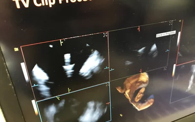 TriClip device visualized using Siemens' new 4D intra-cardiac echo (ICE) catheter. The Acuson AcuNav Volume ICE catheter can help guide not only EP procedures, but also structural heart procedures for tricuspid and mitral TEER and LAA occlusion. The use of ICE can help reduce the number of people needed for a procedure, since the operator is the person guiding the ICE catheter.