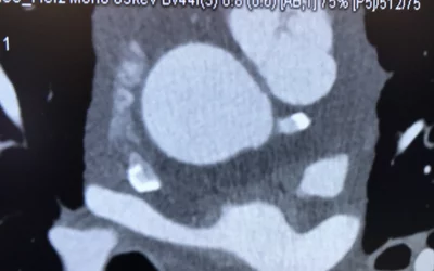 Example case of photon-counting cardiac CT shown by Siemens at it booth today at the American College of Cardiology (ACC) 2022 meeting. The Naeotom Alpha system gained FDA approval in 2021 and is the first photon-counting CT scanner commercially approved. The technology enables all scans to be multi-energy spectral scans because photons of different energies are binned so different energies renderings can be shown. It also allows removal of specific elements, so calcium or metal implants can be removed or 