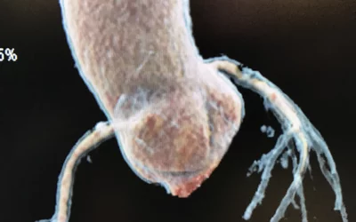 Cardiac CT 3D rendering view of a patient's cardiac CT showing a significant ostial lesions in left and right coronary arteries. Imaged using Siemens' new photon-counting CT scanner on display for the first time since it gained FDA in 2021.