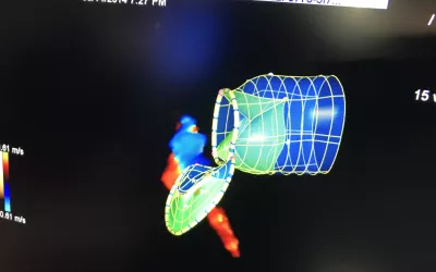Example of mitral valve regurgitation on Siemens'  eSie Valves echocardiography analysis software. The system can automatically render the valve to show this view of the valve and the left ventricular outflow tract (LVOT), which is necessary for assessing patients for both surgical and transcatheter valve replacements. #ACC2022