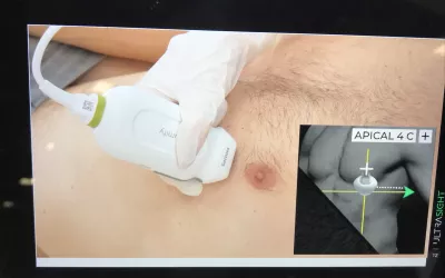 A view from a training video shown by startup artificial intelligence (AI) company UltraSight where the AI will show novice sonographers proper placement and angle of the transducer to get optimal echocardiograms. Cardiac ultrasound image quality depends largely on the operator and can be extremely variable. This AI tool is designed to compensate for this and help make all echo exams comparable across operators, regardless of their level of experience. #ACC22