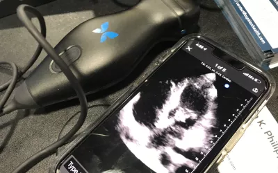The Butterfly System point-of-care ultrasound (POCUS) system uses an app and a transducer to convert a smartphone or iPad into an ultrasound system. This was one of several POCUS systems on display at ACC.22. Butterfly has apps specific to several areas of anatomy, including vascular and cardiac. During COVID, POCUS exploded as a way to get quick looks inside COVID patients with an easy to sterilize imaging system that would not interfere with tubes, ventilators and other equipment. #ACC2022