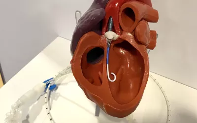 This is a model in the Abiomed booth showing the positioning of an Impella percutaneous hemodynamic support pump in the left ventricle. The pump, inserted via the femoral artery, can offer more support than an IABP. The company created its own database of studies and registry data showing  improved outcomes when used in patients with severely reduced ejection fractions, in need of support during protected PCI, or in cardiogenic shock. #ACC22
