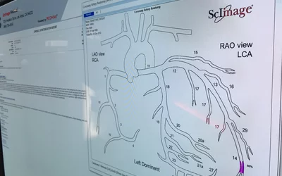 A pop-up interventional cardiology coronary tree diagram that can be annotated with stents, areas of obstructive lesions and measurements that is part of the cath reporting system in the ScImage cardiovascular information system (CVIS). Some vendors offers systems like this that will auto complete sections of the cath report based on the information entered during the procedure and from annotations on the coronary tree. This can help speed report completion. 
