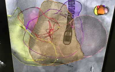 Philips' EchoNavigator technology fuses TEE ultrasound imaging with live fluoro to help navigate devices in the cardiac anatomy during structural heart procedures. 
