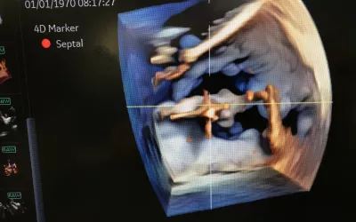 A MitraClip transcatheter mitral valve repair device visualized by a GE NuVision 4D intra-cardiac echo (ICE) catheter. The catheter was co-developed with Biosense Webster to perform EP procedures. It also can be used in place of TEE in structural heart procedures to eliminate the need for an interventional echocardiography. #Acc2022