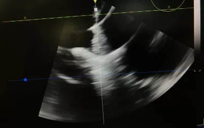 A MitraClip transcatheter mitral valve repair device visualized by a NuVision 4D intra-cardiac echo (ICE) catheter. The Biosense Webster catheter was co-developed with GE. It also can be used in place of TEE in  procedures to eliminate the need for an interventional echocardiography. 