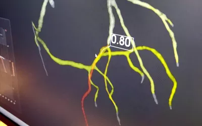 South Korean start-up artificial intelligence company AIMedic displayed its work-in-progress CT angiography algorithm that can derive FFR-CT values for the entire coronary tree in about 30 minutes. The vendor said this can be done onsite without sending datasets offsite using a small server. The company does not have FDA and was gathering feedback from physicians at SCCT.