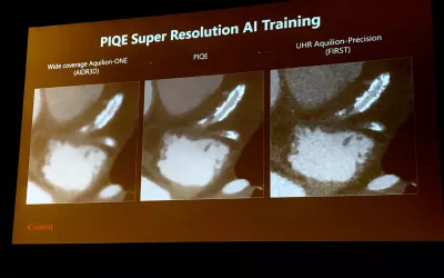 Example showing the difference in image resolution using artificial intelligence (AI) for image reconstruction compared to conventional iterative reconstruction. This example shows Canon's AI-based PIQE CT image reconstruction technology shown in a CT new innovations session. All the major CT vendors are developing AI image reconstruction to greatly improve resolution while enabling lower does CT scans.  #SCCT #SCCT2022 #yesCCT #cardiacCT