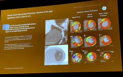 Presentation slide from a new cardiac CT innovations session showing GE Healthcare's whole heart dynamic stress perfusion software the vendor is developing. Vendors are attempting to add more physiological information to CTA so additional tests to examine cardiac function are not needed. #SCCT #SCCT2022 #yesCCT #cardiacCT
