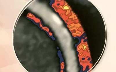 An example of heavy coronary artery inflammation (shown in red) using Caristo's fat attenuation index (FAI) CT imaging assessment software. It  shows inflammation in the fat surrounding the coronary vessels as an indicator if a coronary plaque is inflamed to provide additional information on risk of cardiac events and the progression of vulnerable plaques. The technology has CE mark and they are seeking FDA.#SCCT #SCCT2022 #yesCCT #cardiacCT