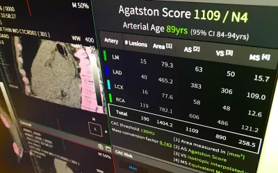 Example of an artificial intelligence (AI) fully automated report and quantitative review of a CT calcium scoring exam shown by the vendor Coreline at SCCT. CAC, or Agatston scoring, can offer patients a 10-year risk assessment for cardiac events. Some cardiologists use it as a way to convince patients to take statins, telling them if they have no calcium they can avoid stains for a few more years. #CAC #SCCT #SCCT2022 #CCTA #CTA