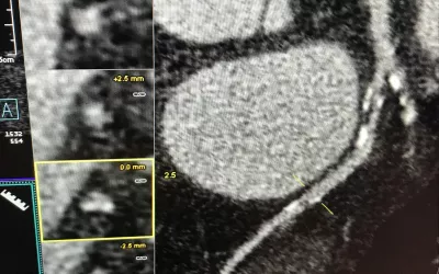 Example of a curved multiplaner reconstruction (Curved MPR) image showing the entire coronary artery in one frame for easier evaluation of the plaques and lumen. #SCCT #SCCT2022 #CTA #CCTA