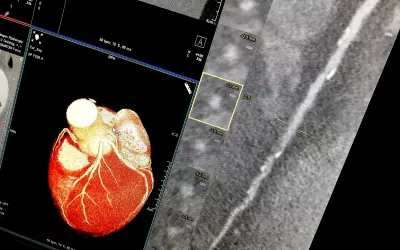 Example of a curved MPR image reconstruction of entire length of a coronary artery on a cardiac CT scan to better show calcified and soft plaque burden inside the vessel. The thumbnail dots on the left side of the image are cross sectional views of the vessel. Siemens example on the expo floor.