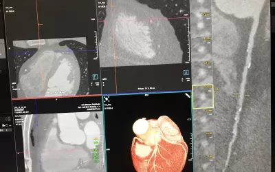 Coronary CT angiography (CCTA) exam showing the heart in three different planes, a 3D reconstruction and a elongated reconstructed view of a coronary artery. The stretched artery view allows assessment on plaque inside the vessel and the small thumbnail images show cross sectional views of the vessel to better understand the plaque and accompanying vessel remodeling. Example is from a Siemens floor demonstration.