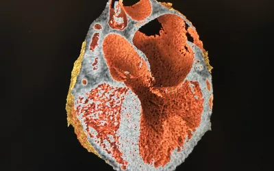Example of photo-realistic CT imaging using the GE Healthcare Volume Illumination feature on its post-processing software, demonstrated on the expo floor of SCCT. #SCCT #SCCT2022 #CCTA #CTA #CardiacCT