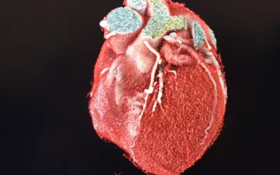 A 3D rendering from a cardiac CT of a patient with a coronary artery bypass graft (CABG). Part of the imaging shown by GE Healthcare from its Revolution Apex CT scanner on the expo floor. #SCCT #CTA #SCCT2022 #yesCCT #CCTA #CABG