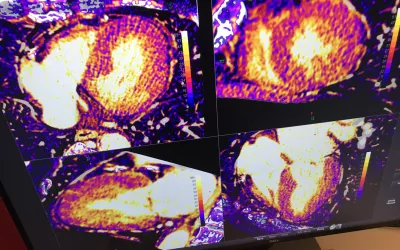 Advanced visualization for CT of the myocardium demonstrated in the Ziosoft booth on the expo floor.#SCCT #SCCT2022 #yesCCT #cardiacCT