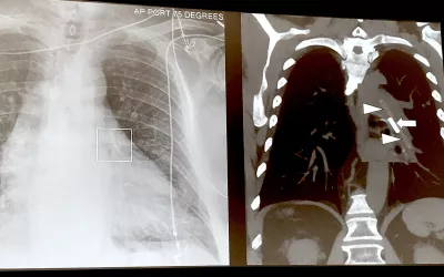 An example of a CardioMEMS implanted heart failure monitor in the pulmonary artery seen in a cardiac CT scan during a presentation at SCCT. Jody Shen, MD, Stanford, presented on uncommon device technologies that pop up on cardiac and CT exams that imagers need to be aware of. She said this device is identified by its wire loops attached at either end. #SCCT #CardioMEMS