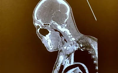 CT showing an intra-aortic balloon pump (IABP) inflated in the aortic arch. Jody Shen, MD, Stanford, presented on uncommon device technologies that pop up on cardiac and CT exams that imagers need to be aware of. #SCCT #SCCT2022 #CCTA