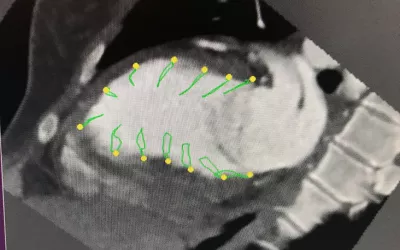 An example of cardiac CT myocardial strain imaging shown in sessions. The vendor Medis also demonstrated this technology of the show floor. It is similar to more commonly used echo strain imaging, which is used to gain more insight into a patient's cardiac function, and is a measure used to cardio-oncology monitoring of cardio-toxicity in patients under going cancer therapy. MRI is also commonly used in serial exam followup, but for patients who cannot undergo MRI, CT is an option. #SCCT2022 #CTstrain