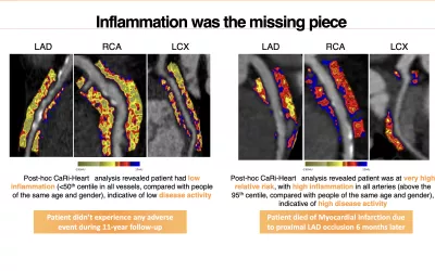 Examples of Caristo's fat attenuation index (FAI) CT imaging of coronary vessel fat to show inflammation. It uses the fat as a indicator it a coronary plaque is inflamed to provide additional information of risk of cardiac events and the progression of vulnerable plaques. It also can show reduction in inflammation due to medical therapy. This can be used to serial scan cardiac patients to better track their disease, better manage drug and life style changes, and enable preventive care. #SCCT #SCCT2022