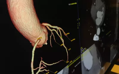 Example of a patient's coronary tree extracted from a cardiac CT scan. CT allows very detailed anatomical imaging and now physiological and plaque information that can be useful in pre-planning interventional procedures. Imaging from the GE Revolution Apex system at SCCT 2022.