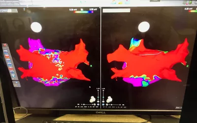 The electro-mapping images show AF arrhythmia activity in the posterior wall of the left atrium, pre and post endovascular ablation following PVI. A new hybrid approach to AFib ablation was shown at the American Heart Association (AHA) meeting by Atricure. It involves both epicardial and endocardial ablations for long standing AF with previous failed ablations. The epicardial ablation system to create scars on the posterior wall of the left atrium, in the space between pulmonary vein isolations (PVIs).
