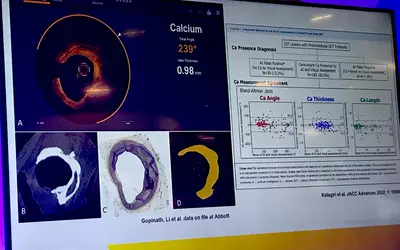 Slides from Abbott Vascular Chief Medical Officer Nick West's presentation on a new deep-learning intravascular imaging technology will use artificial intelligence to offer immediate interpretation of what is seen on intra-coronary imaging.