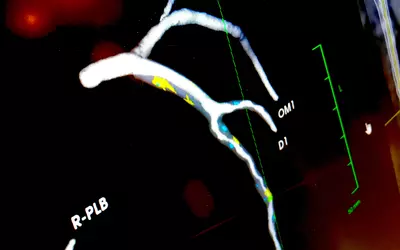 The types of soft plaque color-coded by artificial intelligence on a patient's coronary CT scan by Elucid's AI software.   #AIcardiology #ACC23
