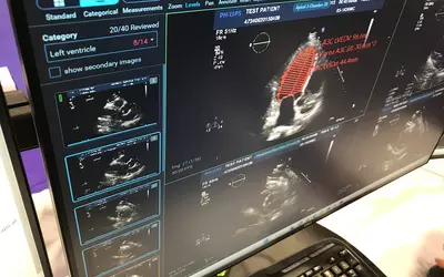 Example of artificial intelligence (AI) integration for automated echo measurements and quantification integrated into the Ascend Cardiovascular CVIS reporting system demonstrated at ACC.23 this past week. Several vendors at ACC showed deeper AI integrations to help speed workflows and standardize quantification in imaging to avoid intra-operator variability. #ACC #ACC23 #CVIS
