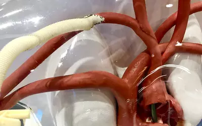 Anatomical model showing an axillary artery vascular access site for an Impella 5.5 catheter heart pump in the Abiomed booth at ACC.23. #ACC #Abiomed
