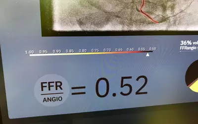 Example of a FFR-angio, image-derived hemodynamic flow model performed table side in the cath lab. It was reconstructed using three different C-arm contrast image acquisitions. This technology from CathWorks can eliminate the need for pressure wires and adenosine to assess FFR pressures. These measurements are used to determine the hemodynamic significance of a stenosis and determine if a stent is necessary or if a patient can be treated medically.