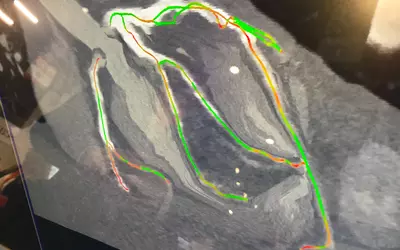 A coronary centerlines overlay on angiography with a color code to show areas of tortuosity. This was shown by Siemens as one of the features on their cath lab angiography imaging systems at ACC.23. It is designed to help improve workflow and understanding of the anatomy during procedures. #ACC #cathlab #ACC23