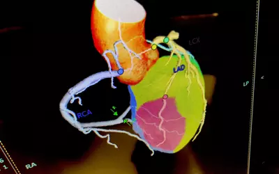 Example of a coronary CT angiography scan 3D rendering of the vessels with automated labeling in the Fujifilm Synapse 7X CVIS system.#ACC23 #ACC