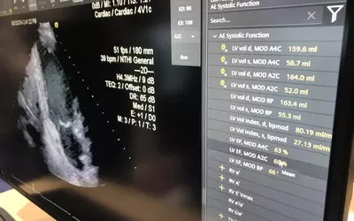 Example of artificial intelligence (AI) automated echocardiogram measurements to save time and to avoid intra-operator variability using the syngo Dynamics cardiovascular information system (CVIS), demonstrated by Siemens at ACC.23.  #ACC ACC23 #AI