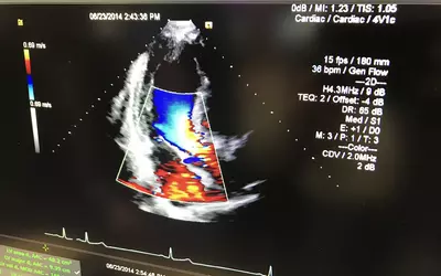 Mitral valve regurgitation seen on echo during a demonstration of the cardiac PACS system in the Siemens booth.