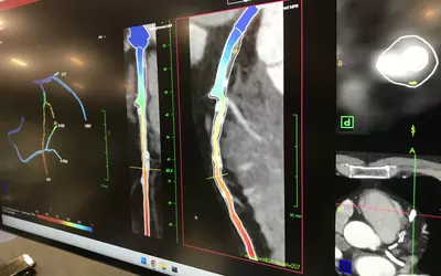 AI vendor Elucid showed a work-in-progress FFR-CT technology that uses an algorithm to assess the soft plaques in the arteries and then determines the hemodynamic flow noninvasively. The company also showed its FDA-cleared AI that performs detailed soft plaque assessment to go beyond calcium scoring for a more accurate measure of patient risk and to monitor the progress of preventive therapies.
