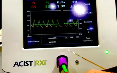 Example of hemodynamic assessment using invasive FFR with a pressurewire with the Acist RXi system at ACC.23.