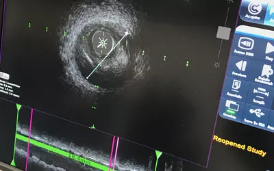 Example of intravascular ultrasound (IVUS) from the Acist HDi system on the expo floor at ACC23.