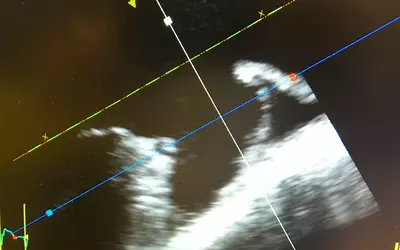 A 4D intracardiac echo (ICE) view of a left atrial appendage for sizing a Watchman device using the GE S70N ultrasound system. 