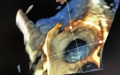 A 4D intracardiac echo (ICE) view of a left atrial appendage using the GE S70N ultrasound system. 