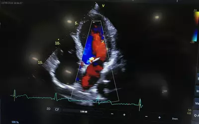 Example of mitral regurgitation seen on an echocardiogram using Doppler flow on a GE Vivid IQ system. #ACC