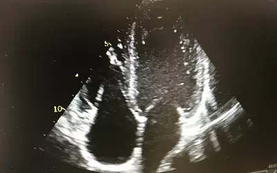 View of a mitral valve seen on an echocardiogram using a GE Vivid IQ system.