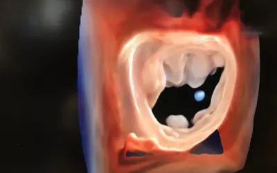 View of a mitral valve seen on a 4D cardiac ultrasound using a Philips 5500CV system.