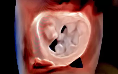 View of a mitral valve showing gaps in the commissures that cause mitral regurgitation. Imaged using 4D cardiac ultrasound on a Philips 5500CV system.