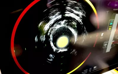 An example of the Nipro combined IVUS and near infrared spectroscopy (NIRS) intravascular imaging system on display at ACC.23. The system has been available for a few years and allows the operator see a color code and location of lipid-rich soft plaques. It was designed to help identify vulnerable plaques inside vessels and add additional information about lesions seen on IVUS. #ACC #IVUS #NIRS